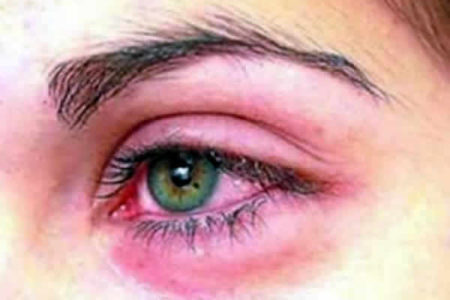 Tempo seco favorece casos de conjuntivite