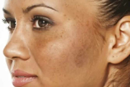 Sintomas do melasma podem piorar no inverno, saiba por que