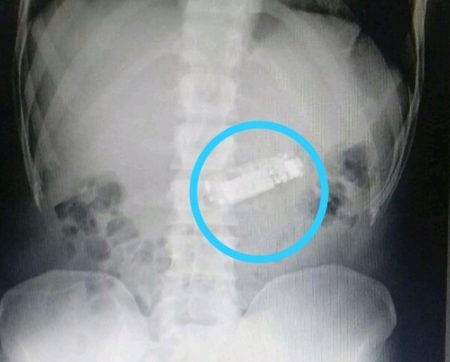 Detento em ‘saidinha’ com celular no estômago passará por cirurgia
