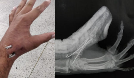 Fratura de Bennett (polegar) em acidente moto x moto