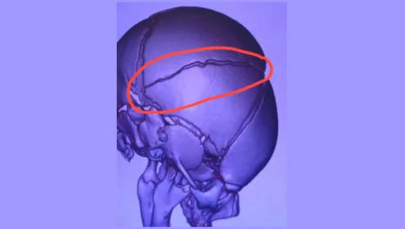 Bebê que caiu de berço sofreu trinca craniana