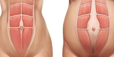 Afastamento abdominal gera dores nas pernas, costas e prejudicar a função dos intestinos!