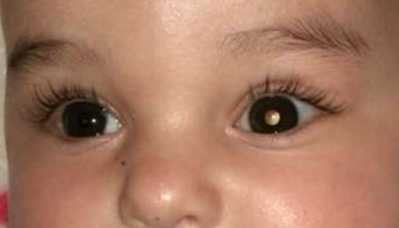 Retinobloastoma: câncer nos olhos da filha do Tiago Leifert