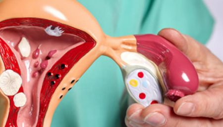 Varizes pélvicas podem ser diagnóstico diferencial para endometriose