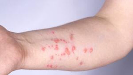 Campinas tem 77 casos de monkeypox