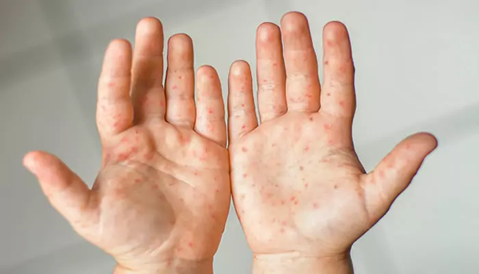 Prefeitura solta nota sobre síndrome mão-pé-boca em escola municipal