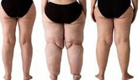 Desvendando o Lipedema: diagnóstico e tratamento de uma doença subestimada