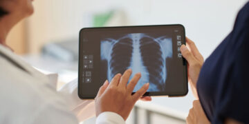 hipertensão pulmonar