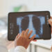 hipertensão pulmonar